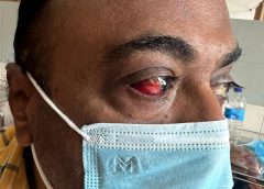 Retired OIC Attacked by Officers from Mahaba Police Station, Suffers Severe Eye Damage